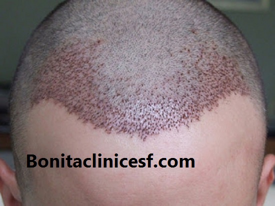 بهترین مرکز کاشت مو در اصفهان - کلینیک بنیتا اصفهان