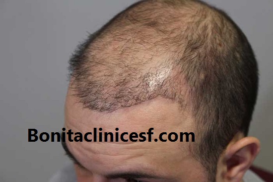 بهترین مرکز کاشت مو در اصفهان - کلینیک بنیتا اصفهان