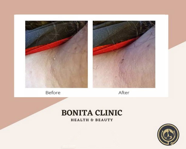 درمان منگوله های پوستی با بهترین قیمت