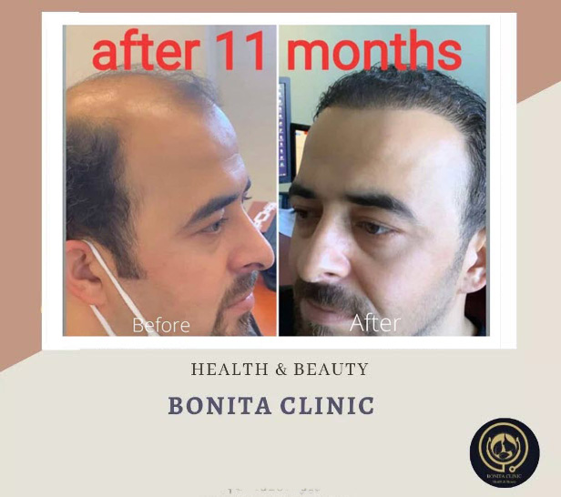 Hair-services-bonitaclinicesf(1) کاشت مو در اصفهان | کلینیک بنیتا