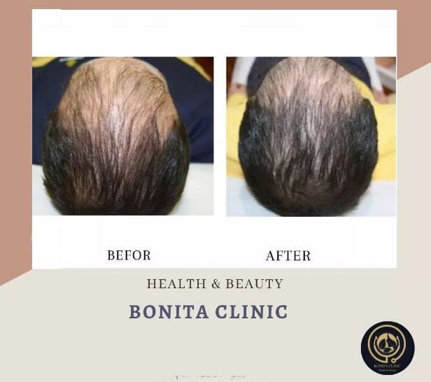 Hair-services-bonitaclinicesf(3) کاشت مو | کلینیک بنیتا اصفهان