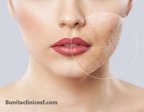 برداشتن اسکارهای پوستی - کلینیک بنیتا اصفهان