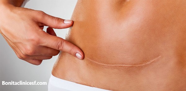 برداشتن اسکارهای پوستی - کلینیک بنیتا اصفهان