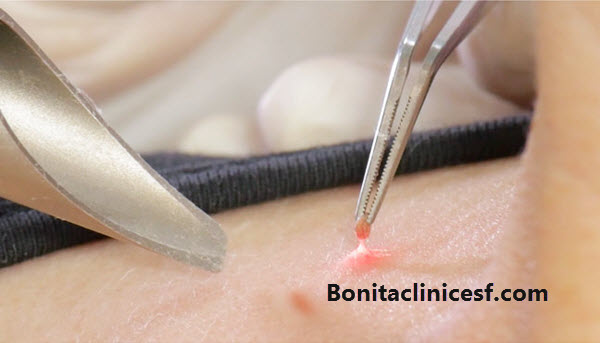 برداشتن خال و زگیل - کلینیک بنیتا اصفهان