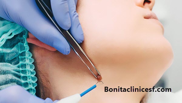 برداشتن خال و زگیل - کلینیک بنیتا اصفهان