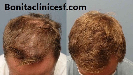 بهترین مرکز کاشت مو در اصفهان - کلینیک بنیتا اصفهان