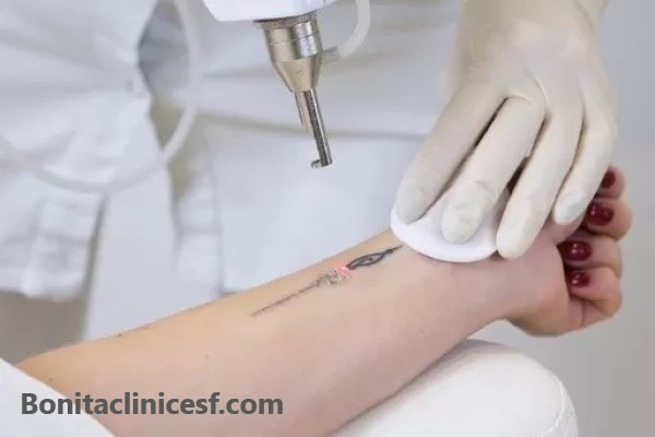 لیزر کیوسوئیچ - کلینیک بنیتا اصفهان