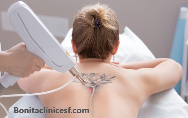 لیزر کیوسوئیچ - کلینیک بنیتا اصفهان