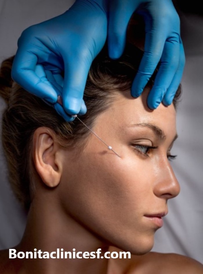 لیفت صورت با نخ - کلینیک بنیتا اصفهان
