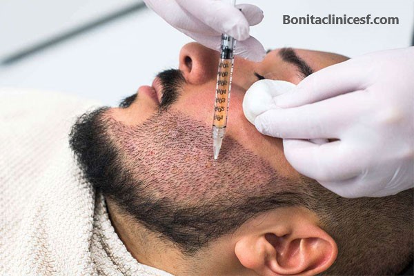 کاشت ریش - کلینیک بنیتا اصفهان