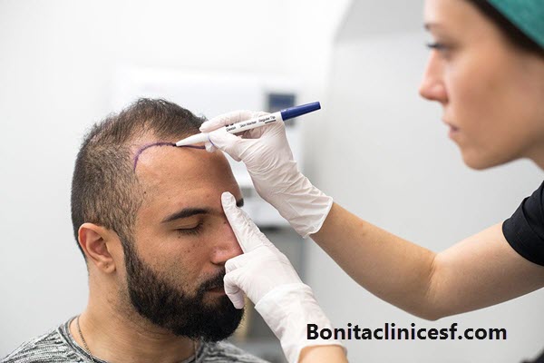 کاشت مو - کلینیک بنیتا اصفهان