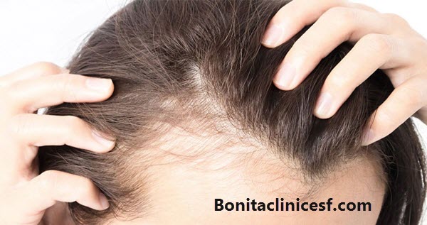 کاشت مو - کلینیک بنیتا اصفهان