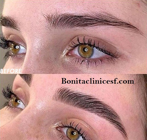 بهترین مرکز کاشت ابرو در اصفهان - کلینیک بنیتا اصفهان
