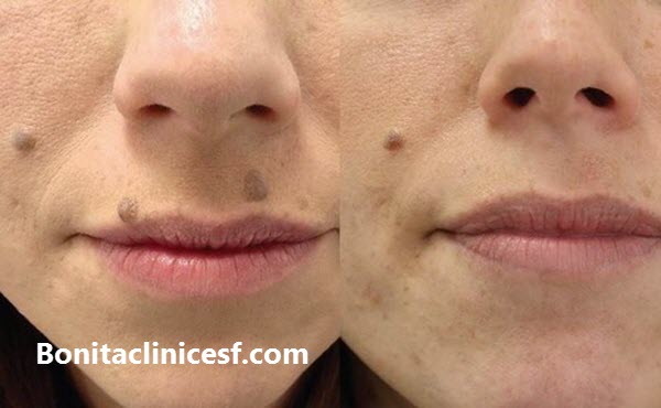 آموزش کار با دستگاه پلاسما و خالبرداری در اصفهان - کلینیک بنیتا اصفهان