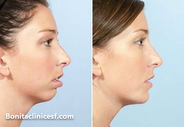 برای تزریق فیلر چانه در اصفهان کجا بریم؟ - کلینیک بنیتا اصفهان