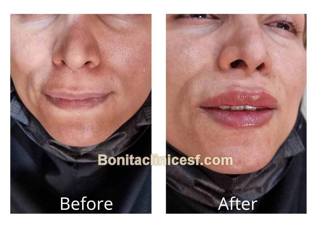 تزریق-ژل-در-اصفهان-کلینیک-بنیتا-bonitaclinicesf.com (1) تزریق ژل در اصفهان | کلینیک بنیتا اصفهان