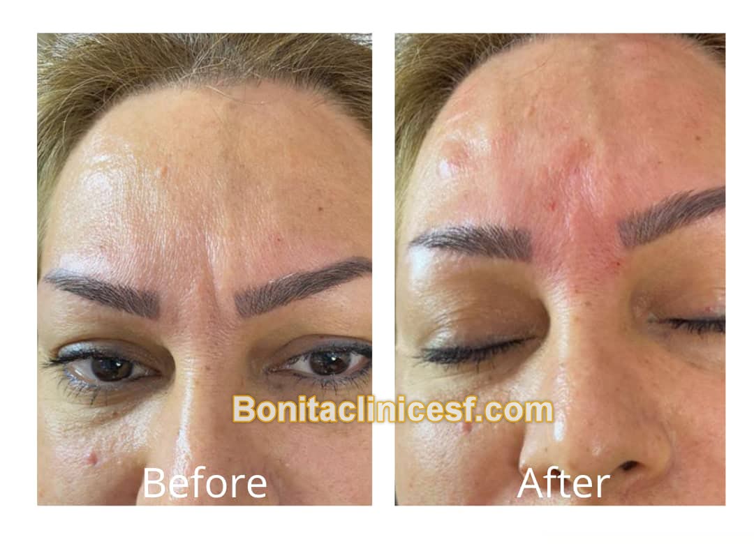 تزریق-ژل-در-اصفهان-کلینیک-بنیتا-bonitaclinicesf.com (10) تزریق ژل در اصفهان | کلینیک بنیتا اصفهان