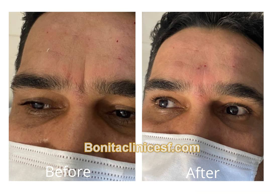 تزریق-ژل-در-اصفهان-کلینیک-بنیتا-bonitaclinicesf.com (11) تزریق ژل در اصفهان | کلینیک بنیتا اصفهان