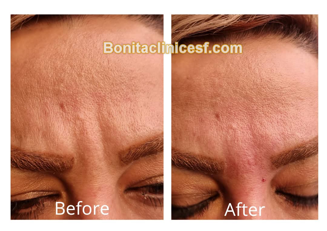 تزریق-ژل-در-اصفهان-کلینیک-بنیتا-bonitaclinicesf.com (12) تزریق ژل در اصفهان | کلینیک بنیتا اصفهان