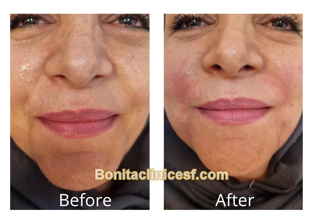 تزریق-ژل-در-اصفهان-کلینیک-بنیتا-bonitaclinicesf.com (13) تزریق ژل در اصفهان | کلینیک بنیتا اصفهان