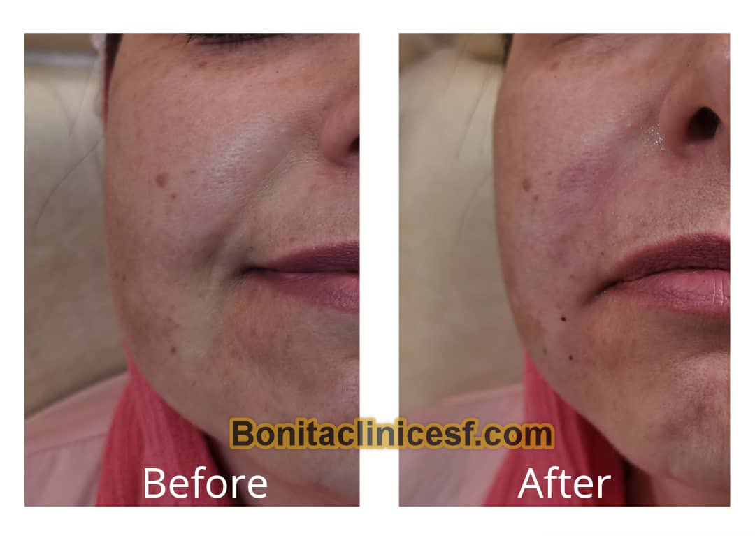 تزریق-ژل-در-اصفهان-کلینیک-بنیتا-bonitaclinicesf.com (15) تزریق ژل در اصفهان | کلینیک بنیتا اصفهان