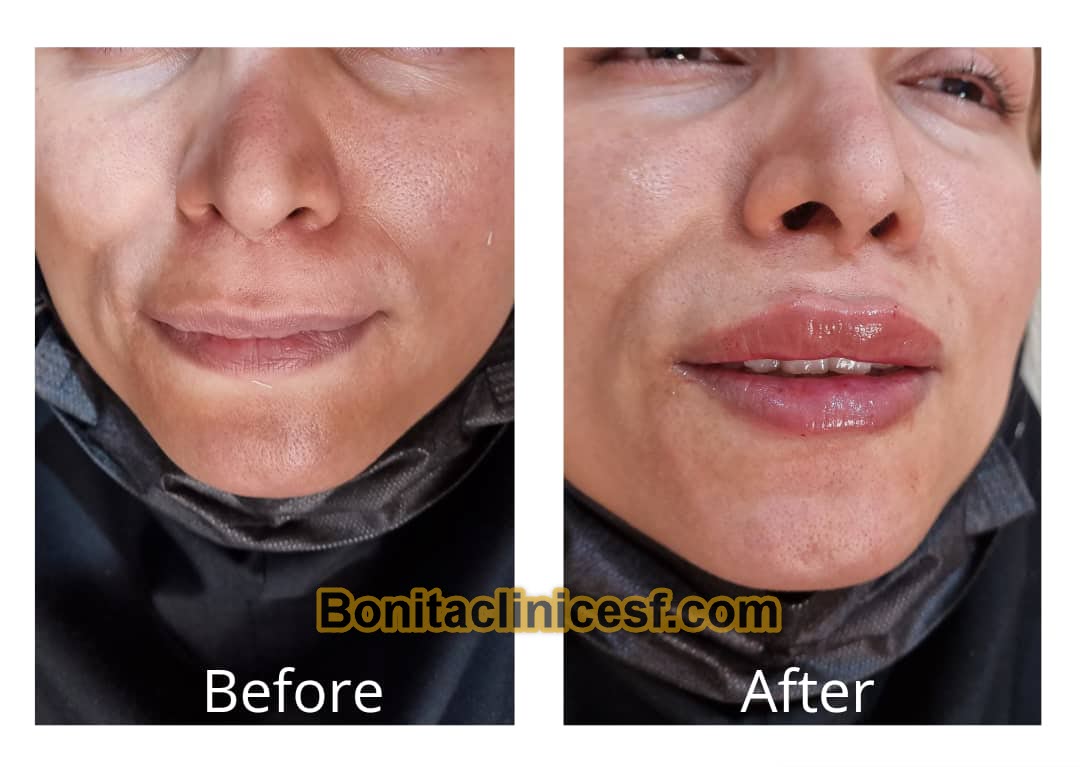 تزریق-ژل-در-اصفهان-کلینیک-بنیتا-bonitaclinicesf.com (16) تزریق ژل در اصفهان | کلینیک بنیتا اصفهان