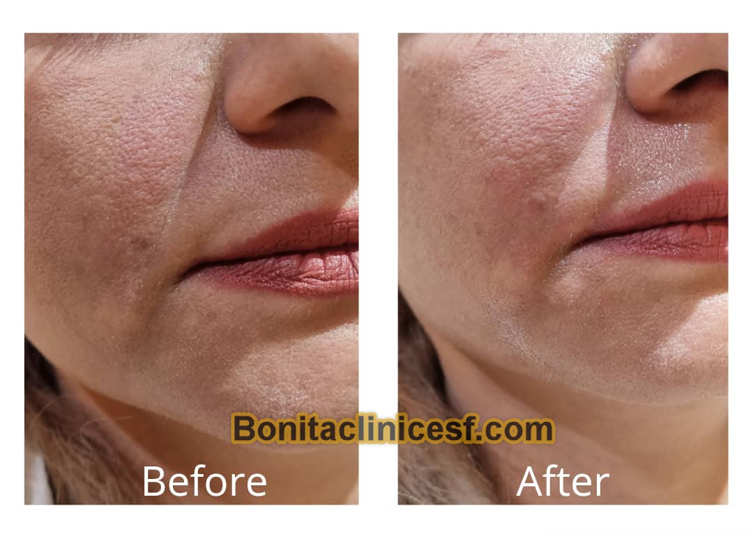 تزریق-ژل-در-اصفهان-کلینیک-بنیتا-bonitaclinicesf.com (17) تزریق ژل در اصفهان | کلینیک بنیتا اصفهان