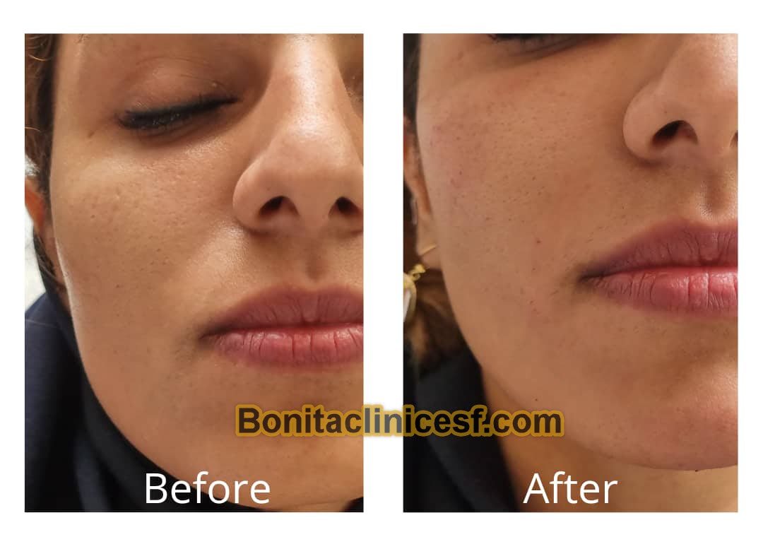 تزریق-ژل-در-اصفهان-کلینیک-بنیتا-bonitaclinicesf.com (19) تزریق ژل در اصفهان | کلینیک بنیتا اصفهان