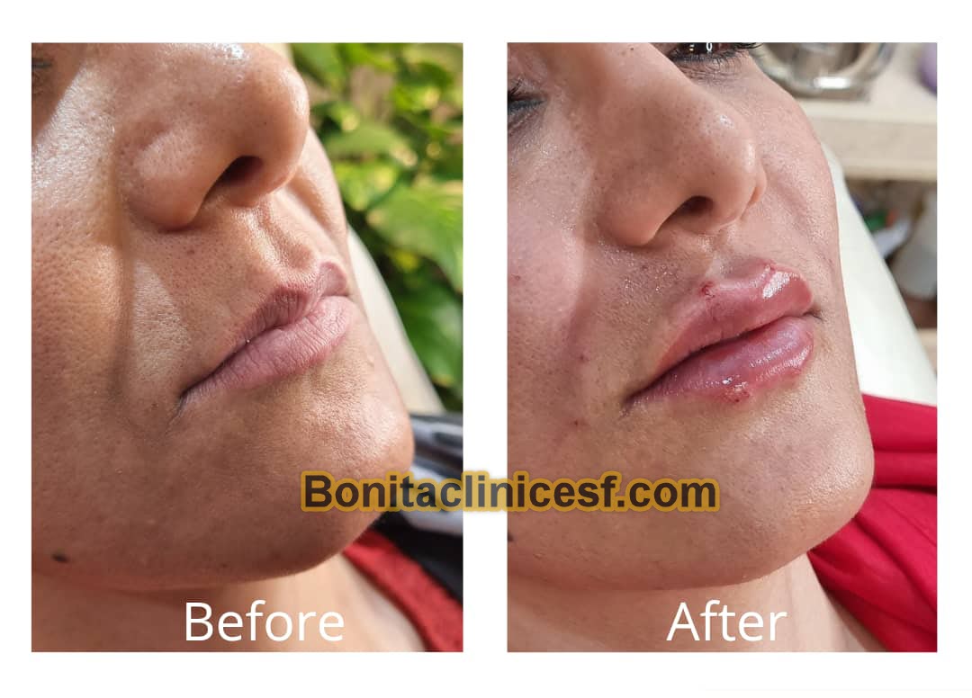 تزریق-ژل-در-اصفهان-کلینیک-بنیتا-bonitaclinicesf.com (2) تزریق ژل در اصفهان | کلینیک بنیتا اصفهان