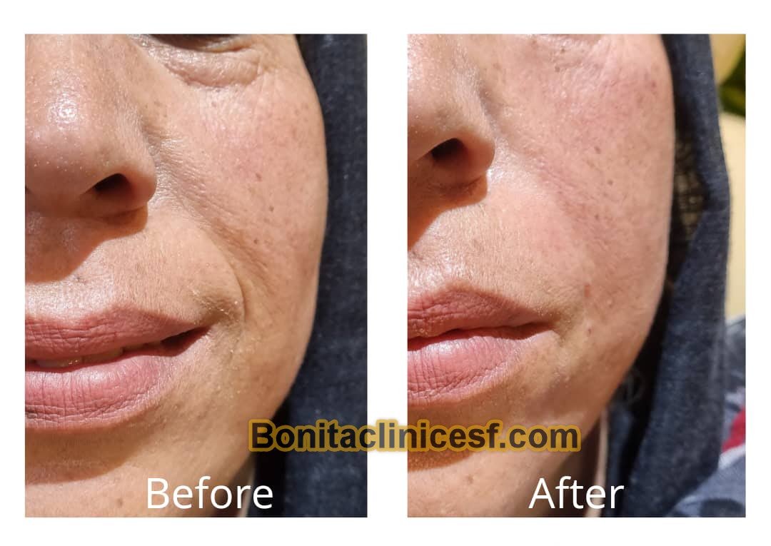 تزریق-ژل-در-اصفهان-کلینیک-بنیتا-bonitaclinicesf.com (20) تزریق ژل در اصفهان | کلینیک بنیتا اصفهان