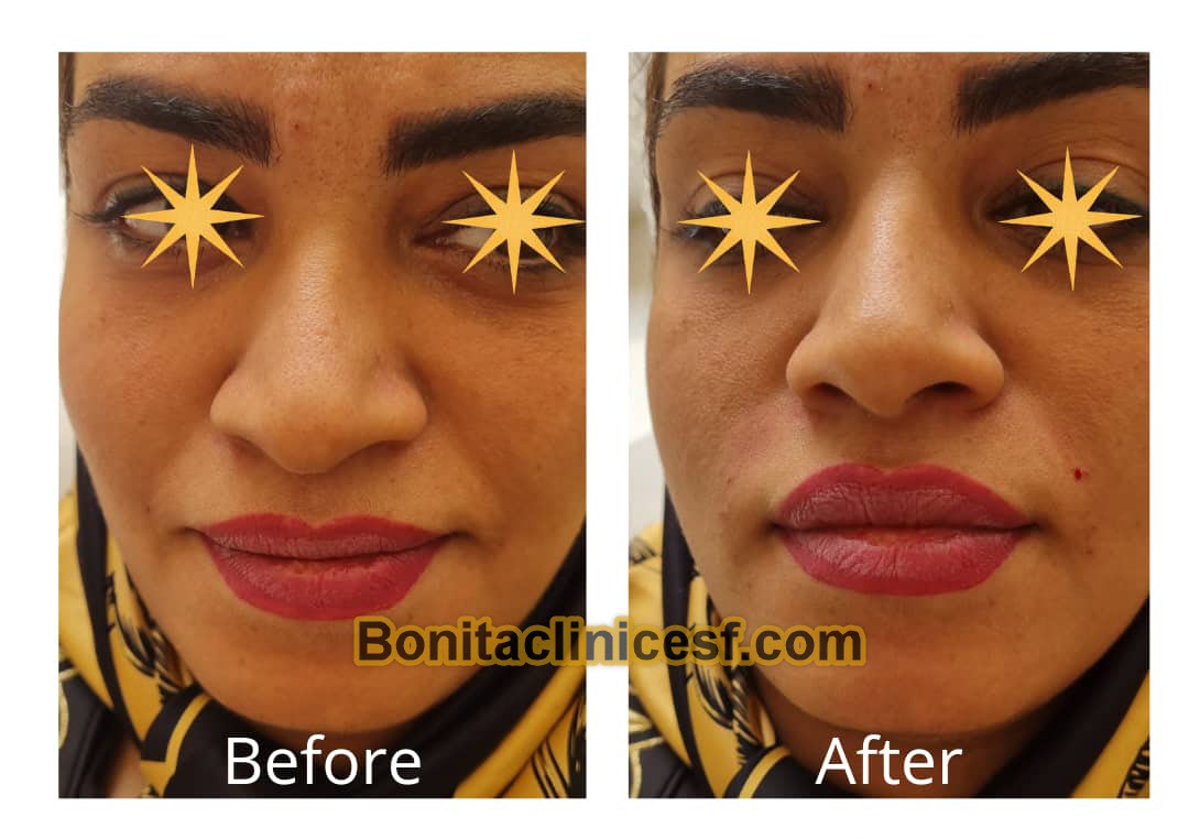 تزریق-ژل-در-اصفهان-کلینیک-بنیتا-bonitaclinicesf.com (22) تزریق ژل در اصفهان | کلینیک بنیتا اصفهان