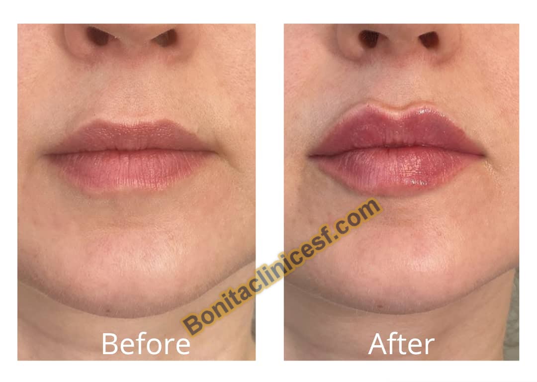 تزریق-ژل-در-اصفهان-کلینیک-بنیتا-bonitaclinicesf.com (4) تزریق ژل در اصفهان | کلینیک بنیتا اصفهان