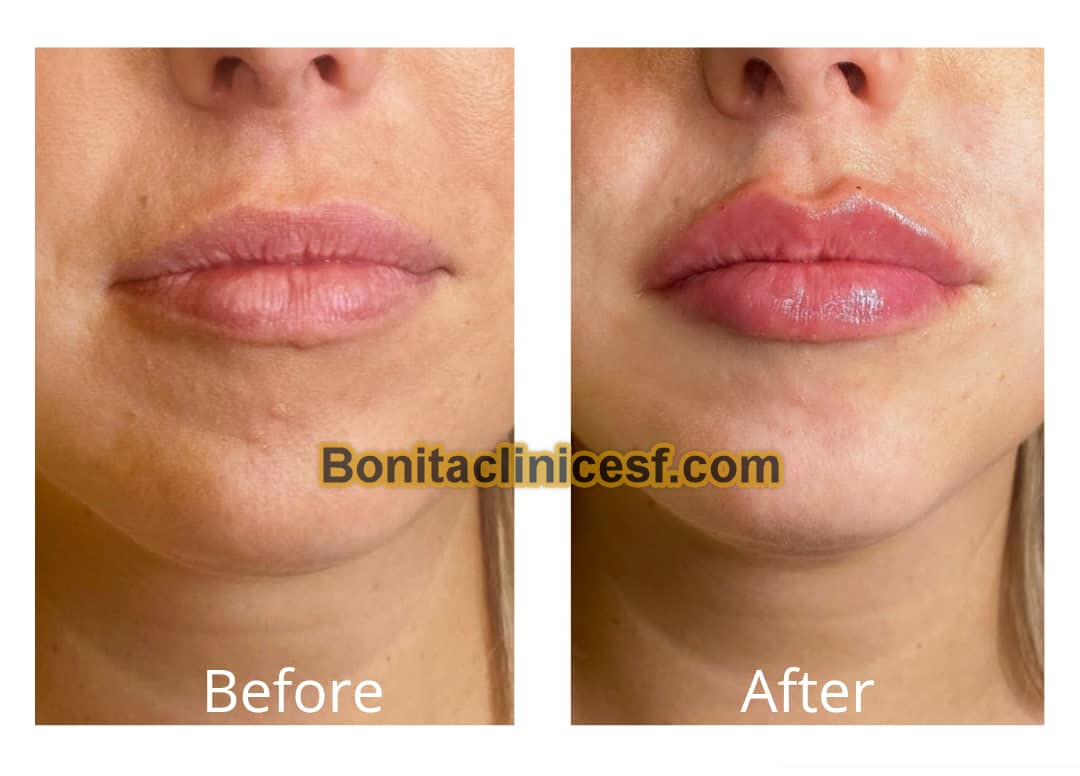 تزریق-ژل-در-اصفهان-کلینیک-بنیتا-bonitaclinicesf.com (5) تزریق ژل در اصفهان | کلینیک بنیتا اصفهان