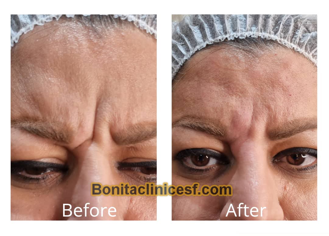 تزریق-ژل-در-اصفهان-کلینیک-بنیتا-bonitaclinicesf.com (6) تزریق ژل در اصفهان | کلینیک بنیتا اصفهان