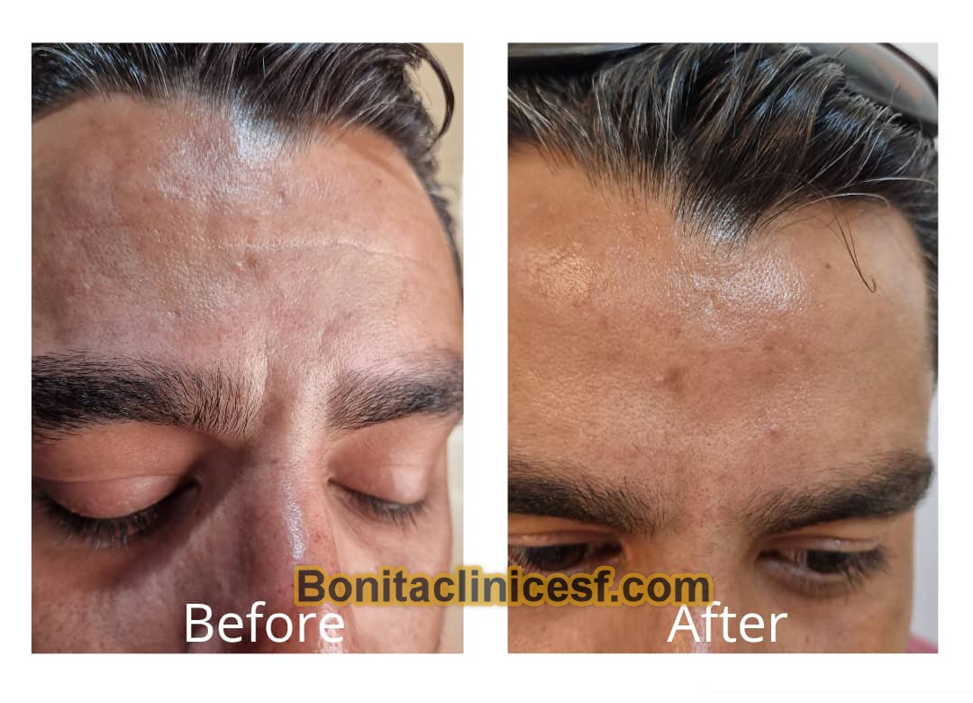 تزریق-ژل-در-اصفهان-کلینیک-بنیتا-bonitaclinicesf.com (7) تزریق ژل در اصفهان | کلینیک بنیتا اصفهان