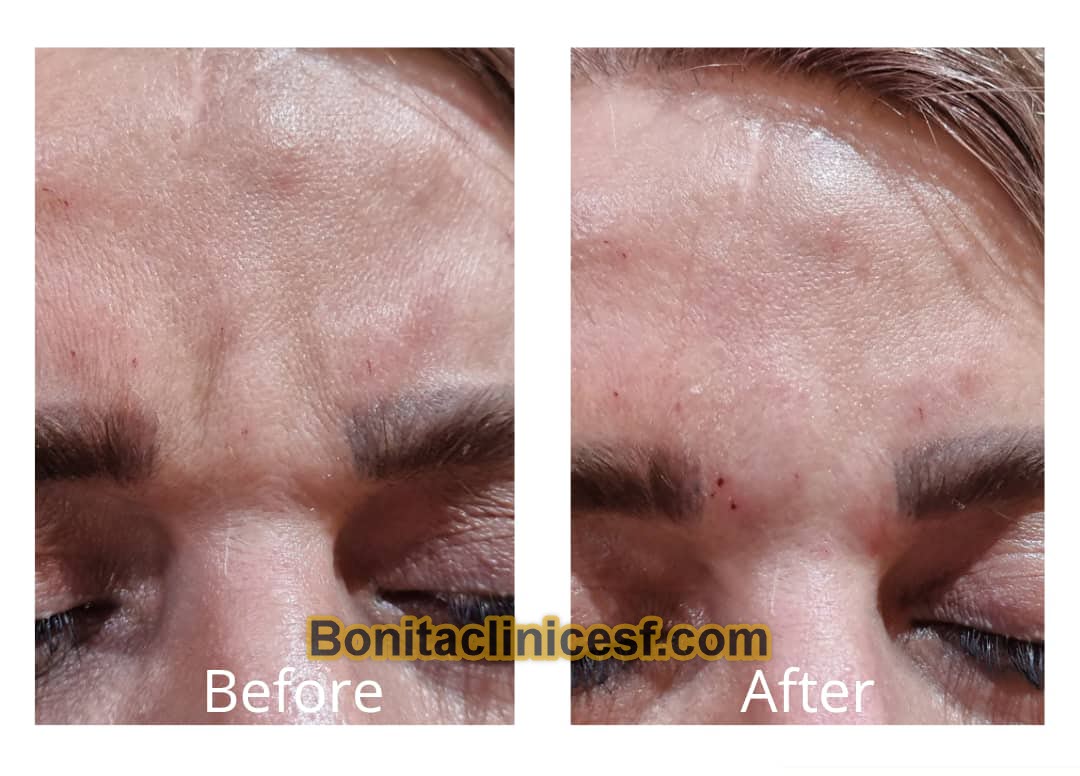 تزریق-ژل-در-اصفهان-کلینیک-بنیتا-bonitaclinicesf.com (8) تزریق ژل در اصفهان | کلینیک بنیتا اصفهان