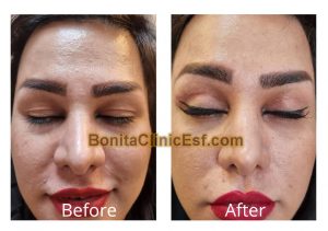 بلفاروپلاستی در اصفهان | کلینیک بنیتا