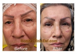 بلفاروپلاستی در اصفهان | کلینیک بنیتا