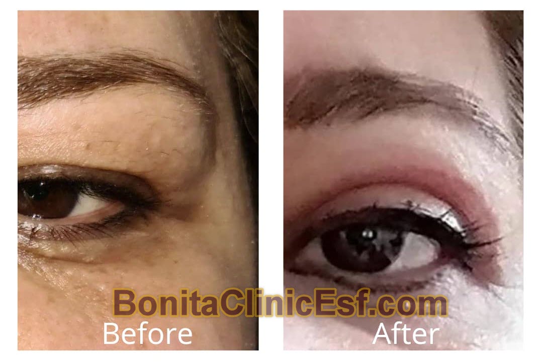 بلفاروپلاستی در اصفهان | کلینیک بنیتا