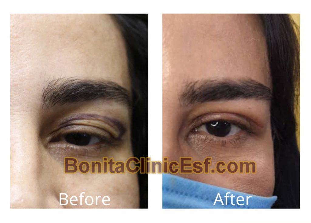 بلفاروپلاستی در اصفهان | کلینیک بنیتا