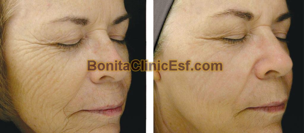 هایفوتراپی در اصفهان | کلینیک بنیتا