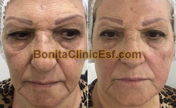 هایفوتراپی در اصفهان | کلینیک بنیتا