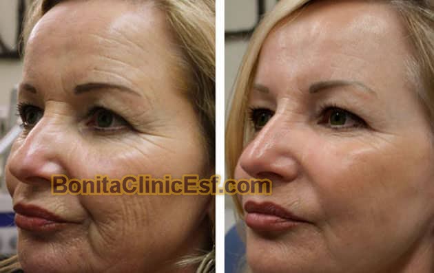 هایفوتراپی در اصفهان | کلینیک بنیتا