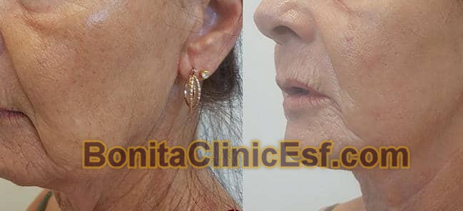 هایفوتراپی در اصفهان | کلینیک بنیتا