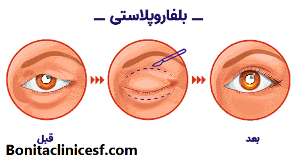 بلفاروپلاستی چیست؟-کلینیک بنیتا در اصفهان