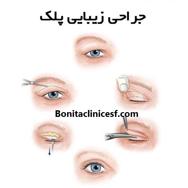 بهترین جراح بلفاروپلاستی در اصفهان - کلینک بنیتا اصفهان