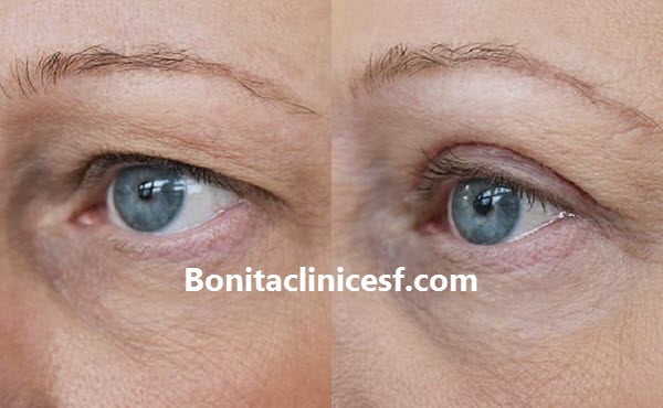 بهترین جراح بلفاروپلاستی در اصفهان - کلینک بنیتا اصفهان