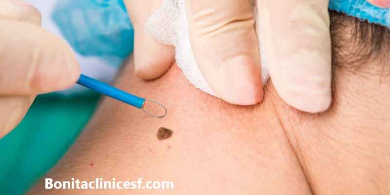 بهترین دکتر برای برداشتن خال در اصفهان - کلینیک بنیتا