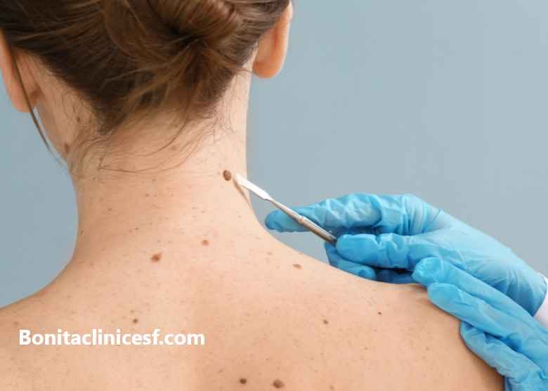 بهترین دکتر برای برداشتن خال در اصفهان - کلینیک بنیتا