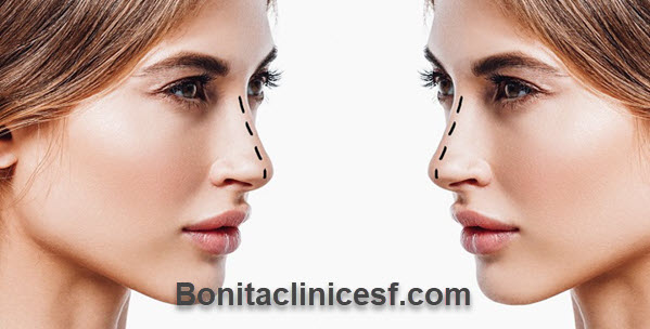 کلینیک زیبایی اصلاح فرم بینی در اصفهان | کلینیک بنیتا اصفهان